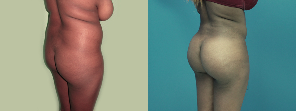 Brazilian Butt Lift before and after 