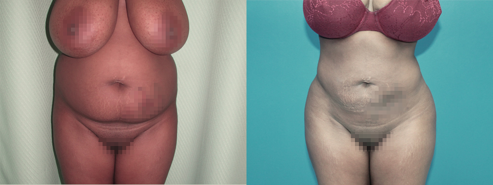 Brazilian Butt Lift before and after