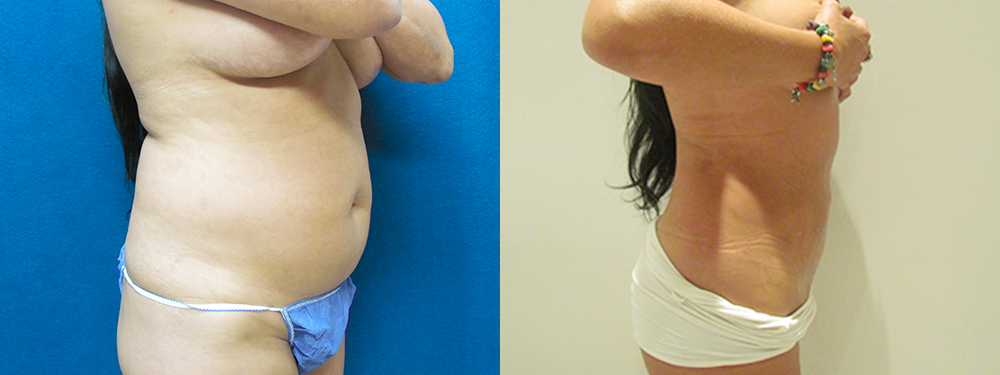Liposuction before and after photos 