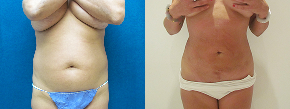 Liposuction before and after photos 