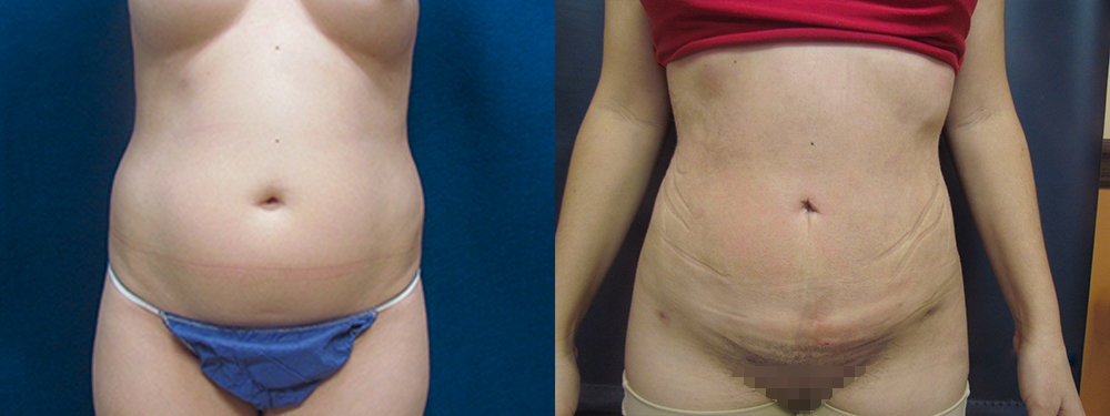 Liposuction before and after photos 