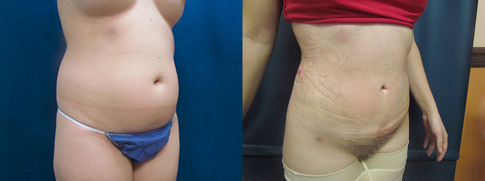Liposuction before and after photos 