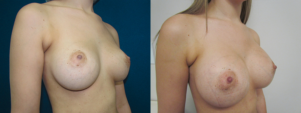 Breast Augmentation before and after 