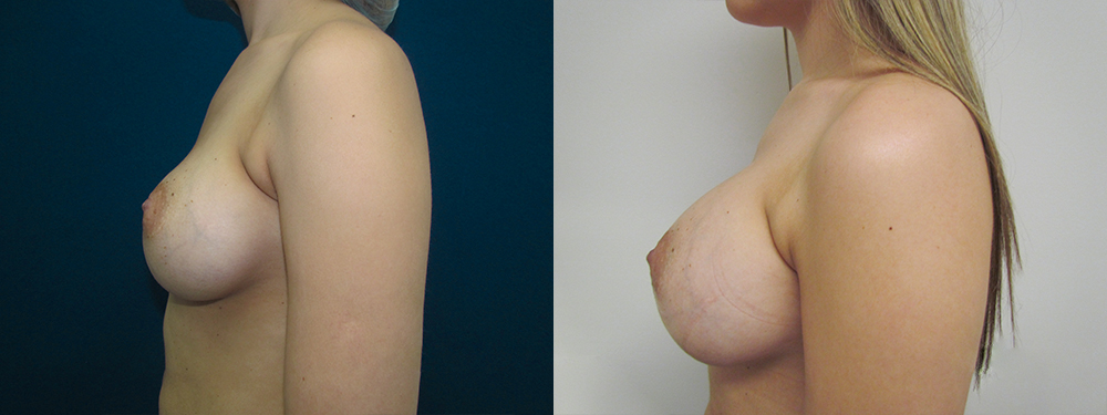 Breast Augmentation before and after 