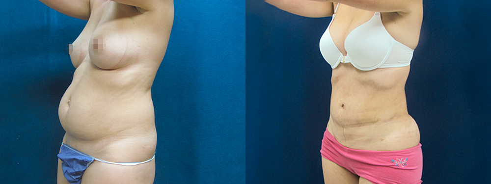 Liposuction before and after photos