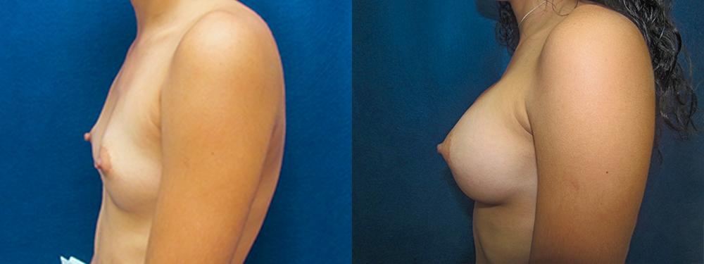 breast augmentation before and after