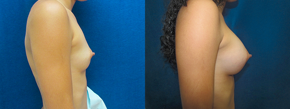 breast augmentation before and after
