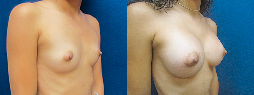 breast augmentation before and after