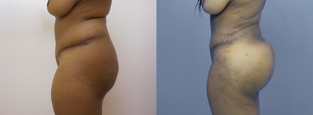 Brazilian Butt Lift befoer and after photos