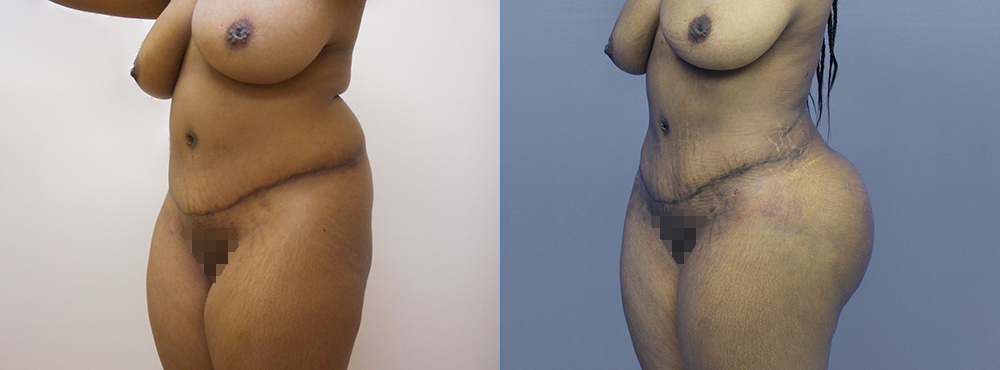 Brazilian Butt Lift befoer and after photos