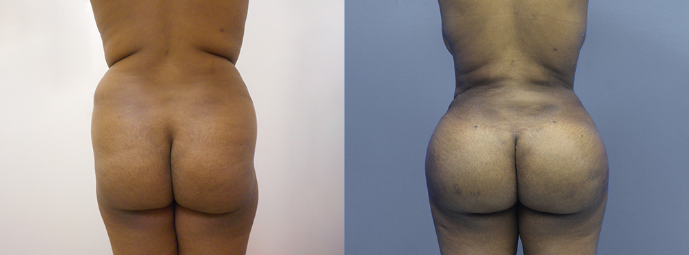 Brazilian Butt Lift befoer and after photos