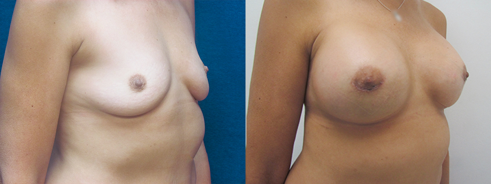 Breast augmentation before and after