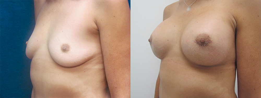 Breast augmentation before and after