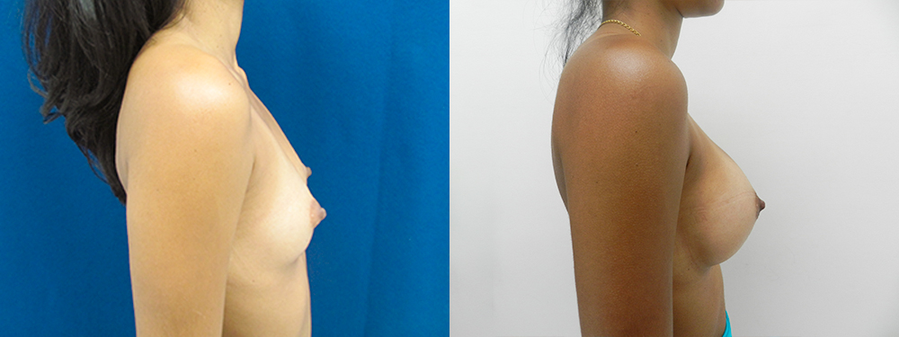 breast augmentation before and after