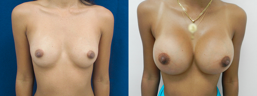 breast augmentation before and after