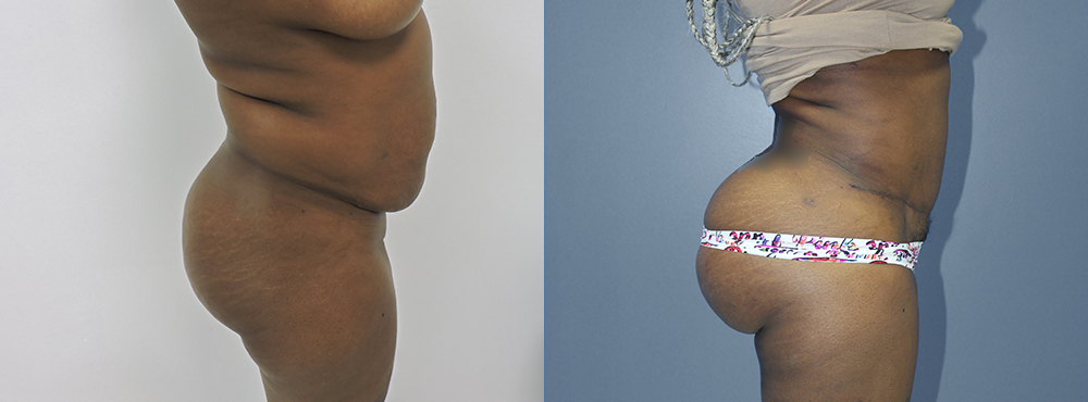 Brazilian Butt Lift before and after photos