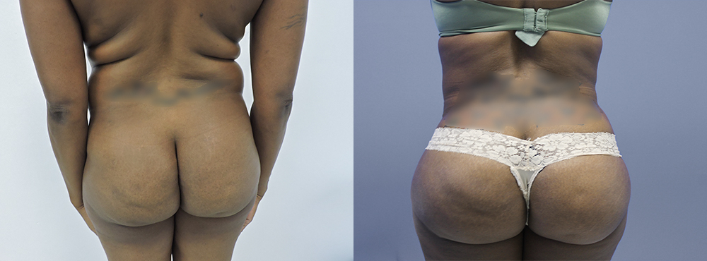 Brazilian Butt Lift before and after photos