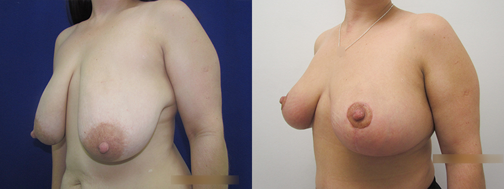 Breast Reduction before and after