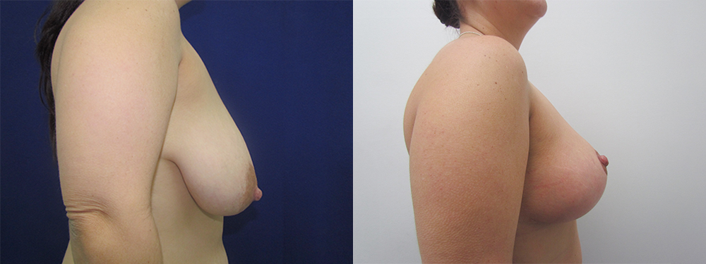 Breast Reduction before and after