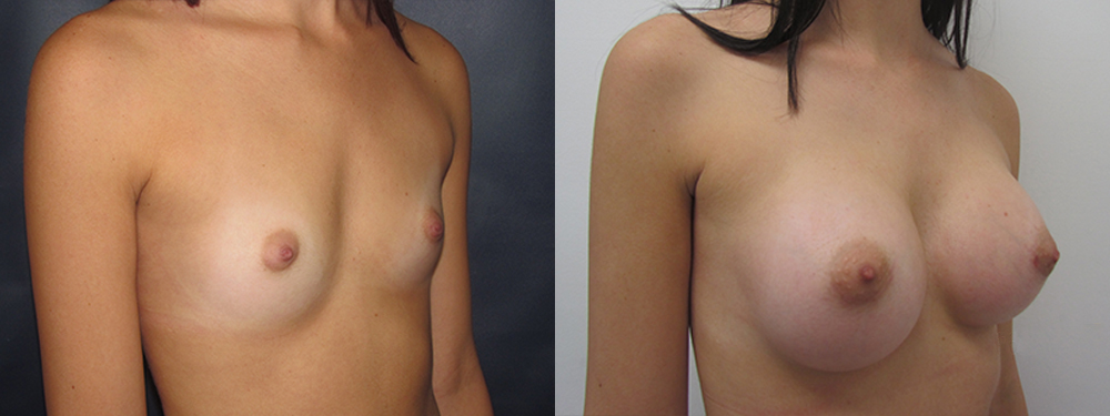 breast augmentation before and after