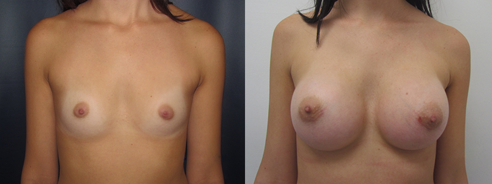 breast augmentation before and after