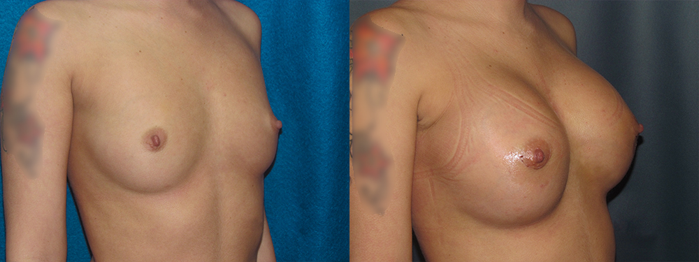 brest augmentation before and after