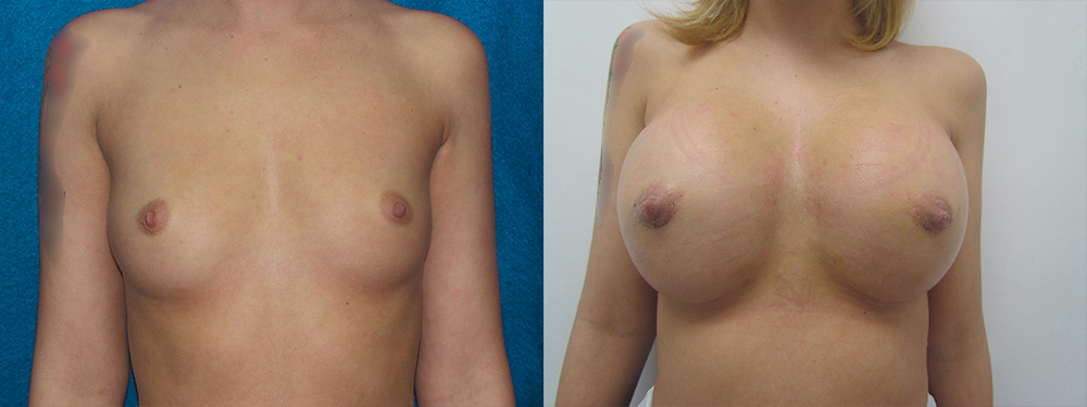 brest augmentation before and after