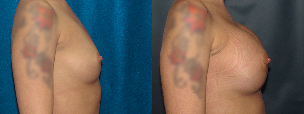 brest augmentation before and after