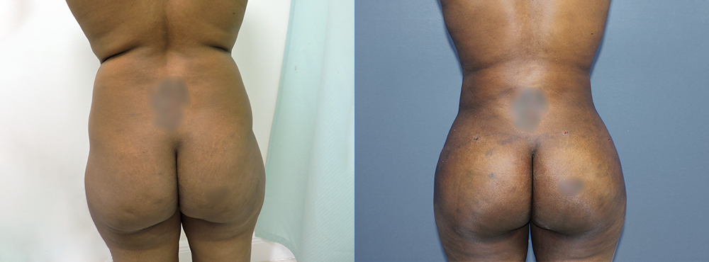 Brazilian Butt Lift befoer and after photos