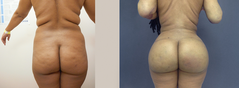 Brazilian Butt Lift befoer and after photos