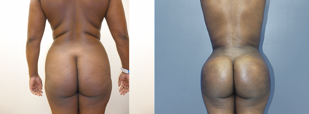 Brazilian Butt Lift befoer and after photos