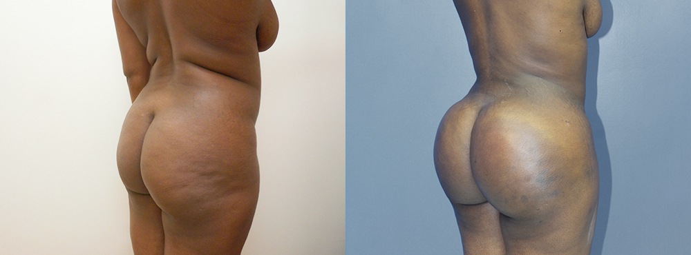 Brazilian Butt Lift befoer and after photos
