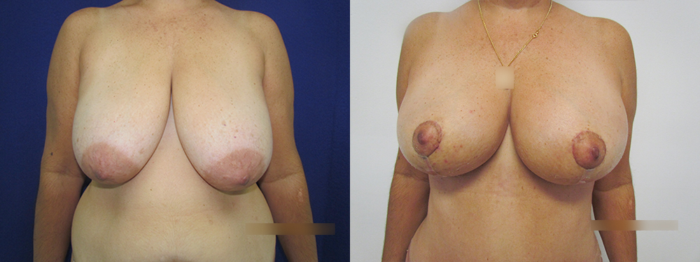 Breast Reduction before and after