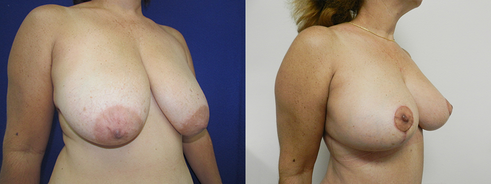 Breast Reduction before and after