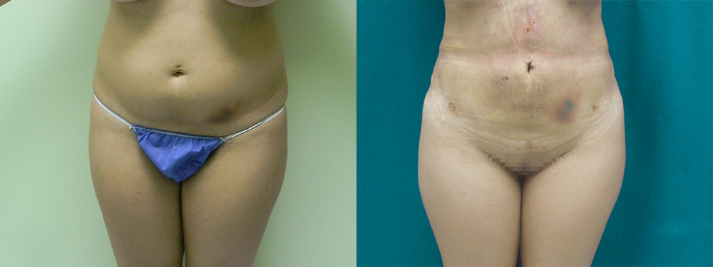 Brazilian Butt Lift before and after