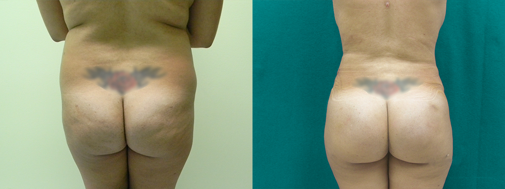 Brazilian Butt Lift before and after
