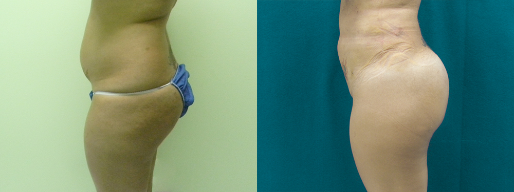 Brazilian Butt Lift before and after
