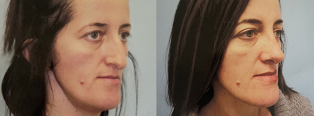 Rhinoplasty Before and After  ReNova Plastic Surgery & Medical Spa