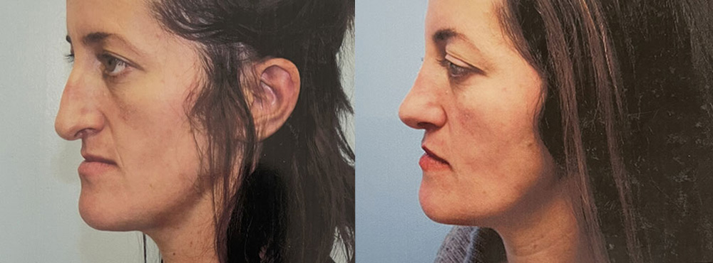 Rhinoplasty Before and After  ReNova Plastic Surgery & Medical Spa