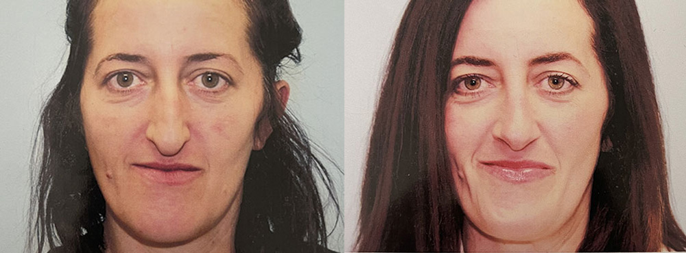 Rhinoplasty Before and After