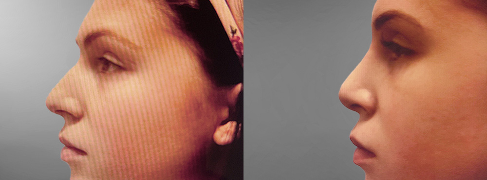 Rhinoplasty Before and After