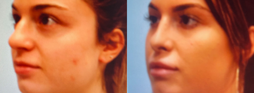 Rhinoplasty Before and After