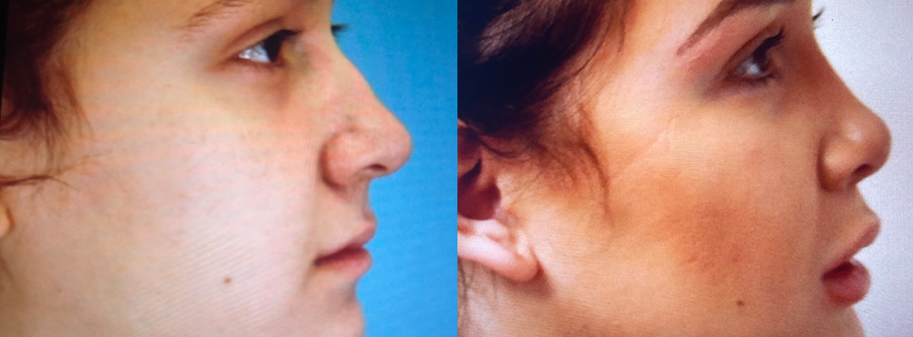 Rhinoplasty Before and After