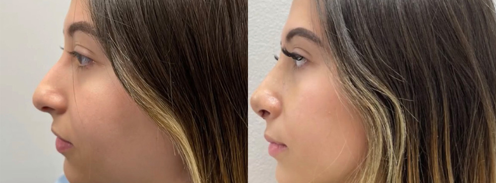 Rhinoplasty Before and After