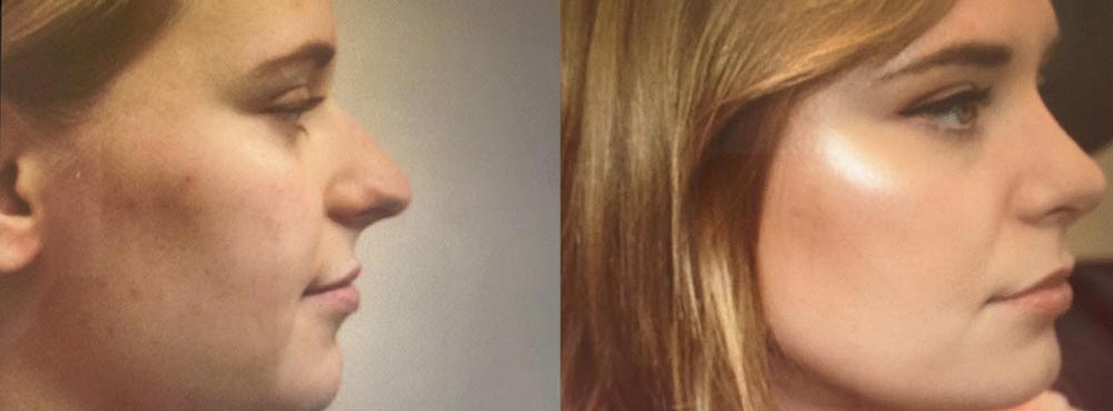 Rhinoplasty Before and After