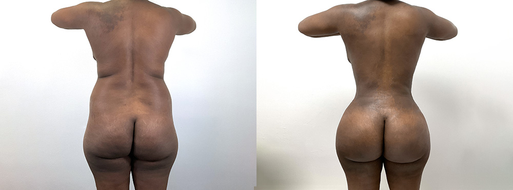 BBL Before and After