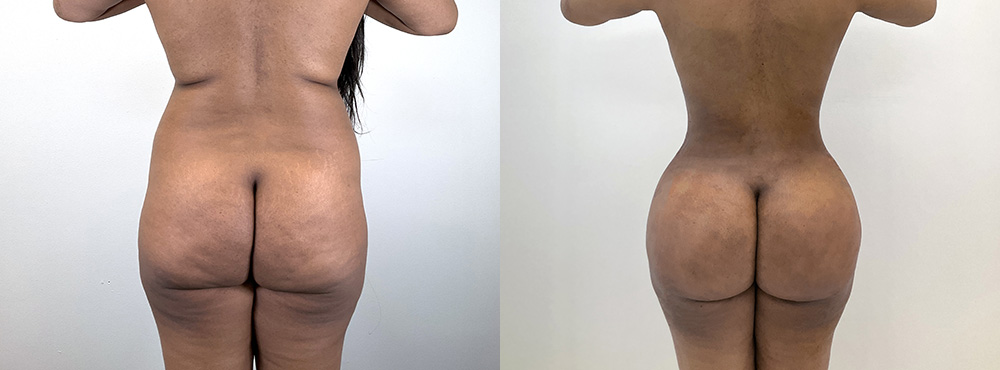 BBL Before and After