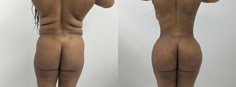 BBL Before and After