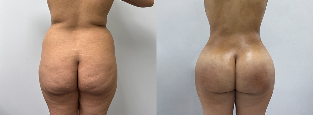 BBL Before and After