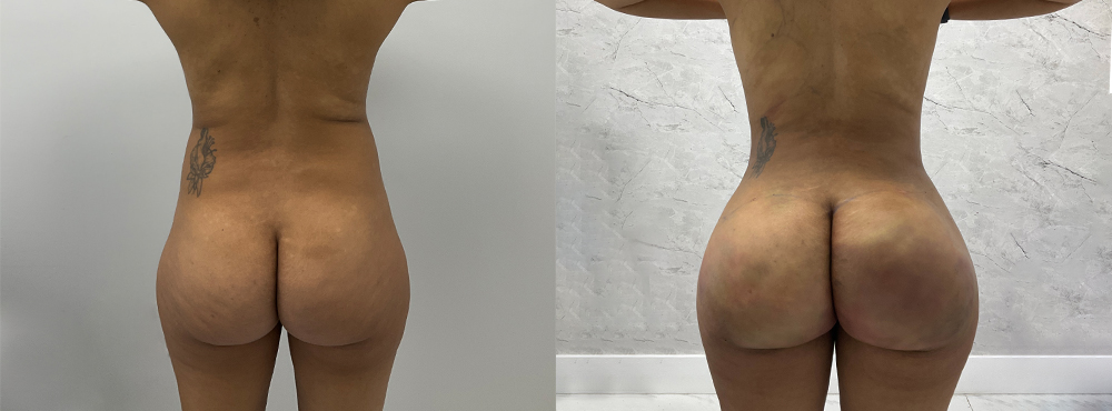 BBL Before and After